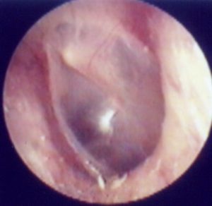 滲出性中耳炎図2